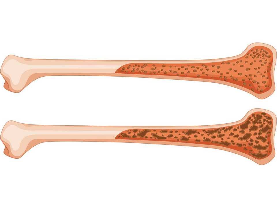 VITAMIN D AND SCOLIOSIS